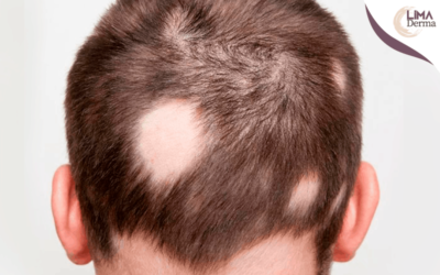 ¿Qué es la alopecia y cómo tratarla?