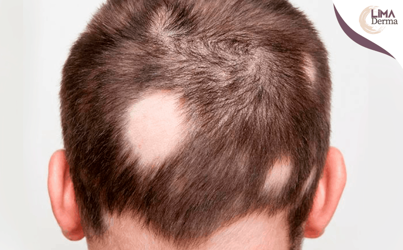 ¿Qué es la alopecia y cómo tratarla?