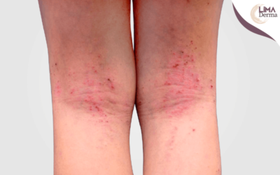 Dermatitis Atópica en Niños: Causas, Síntomas y Tratamientos