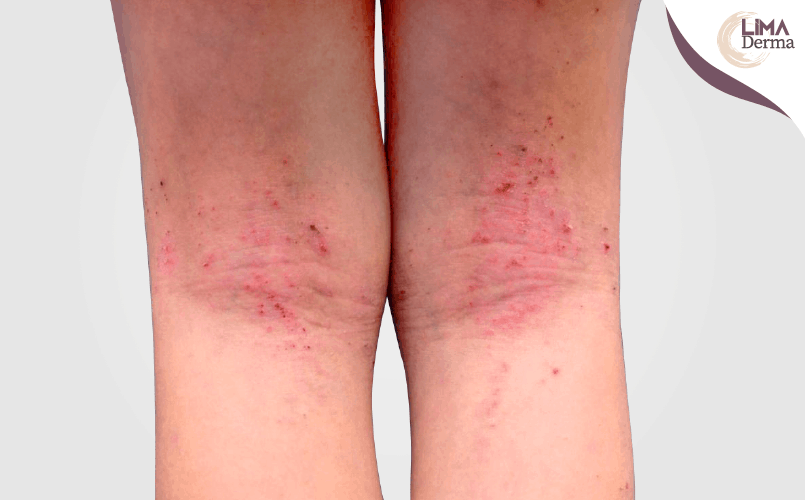 Dermatitis Atópica en Niños: Causas, Síntomas y Tratamientos