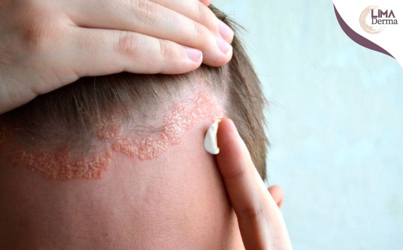 causas de la Dermatitis Seborreica - Caspa