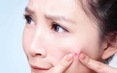 Problemas en la piel por estrés: Cómo tratarlos
