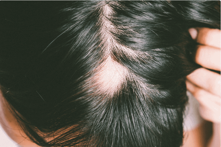alopecia - caida del cabello
