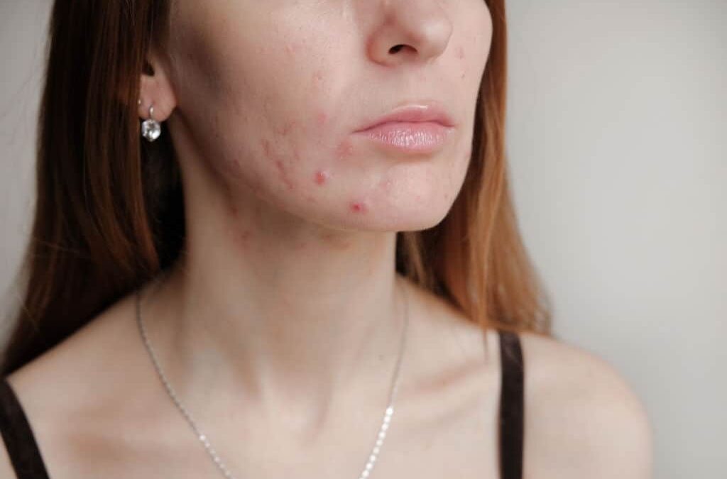 Tipos de cicatrices de acné y cómo tratarlas