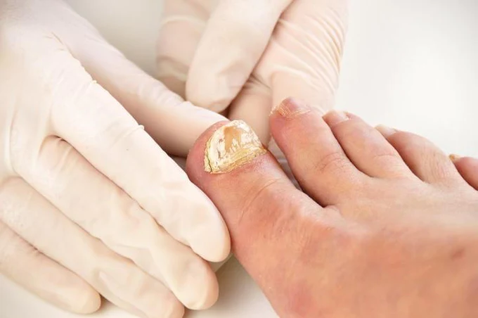 Onicomicosis: hongo en las uñas de manos y pies